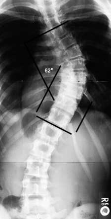 SCOLIOSIS PERSPECTIVE