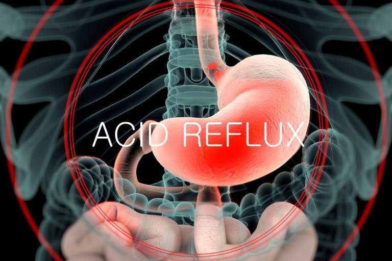 Chiropractic and Acid Reflux Gerd