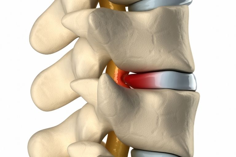 Spinal Disc