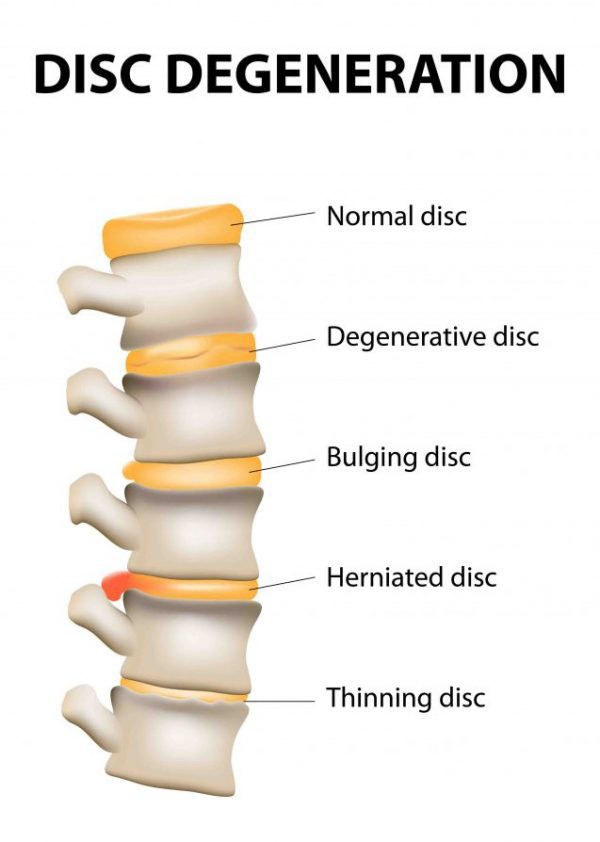 Slipped Disc Treatment In Bangalore